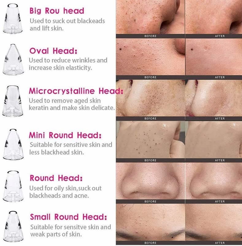 Vacuum Pore Cleaner, 5 In 1 Blackheads Removing Device Electric Derma suction Machine | USB Rechargeable Acne Pimple Pore Cleaner Vacuum tool - Facial Cleanser Device for Nose & Skin Care